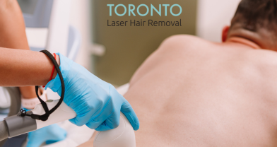 laser hair removal Toronto 