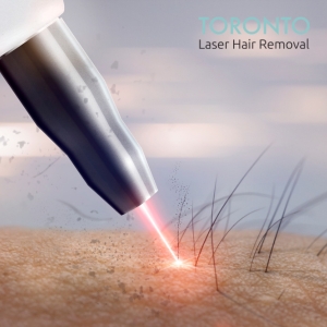 laser hair removal Toronto