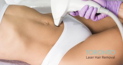 laser hair removal Toronto